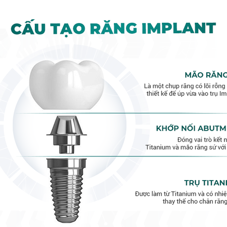 TRỒNG RĂNG IMPLANT